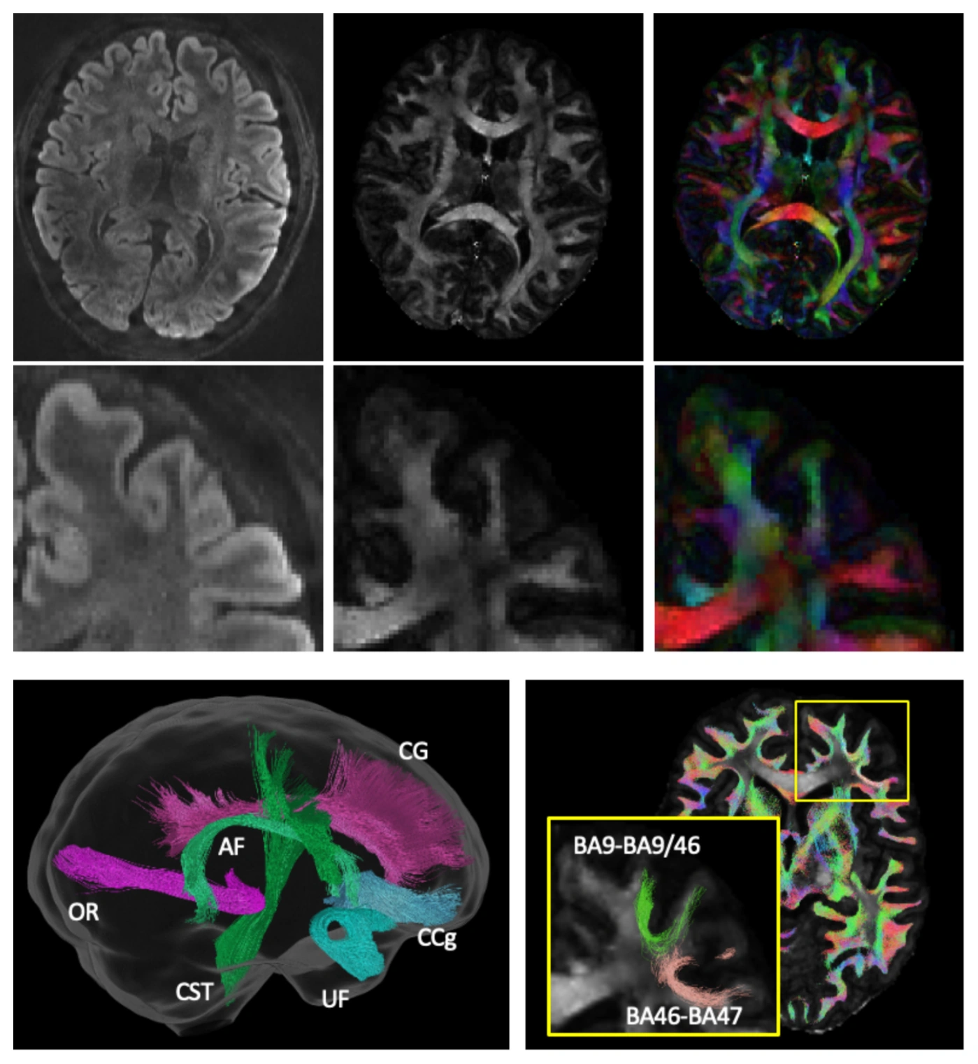 High-resolution diffusion images and tractography from the four-direction phase-encoding acquisition.