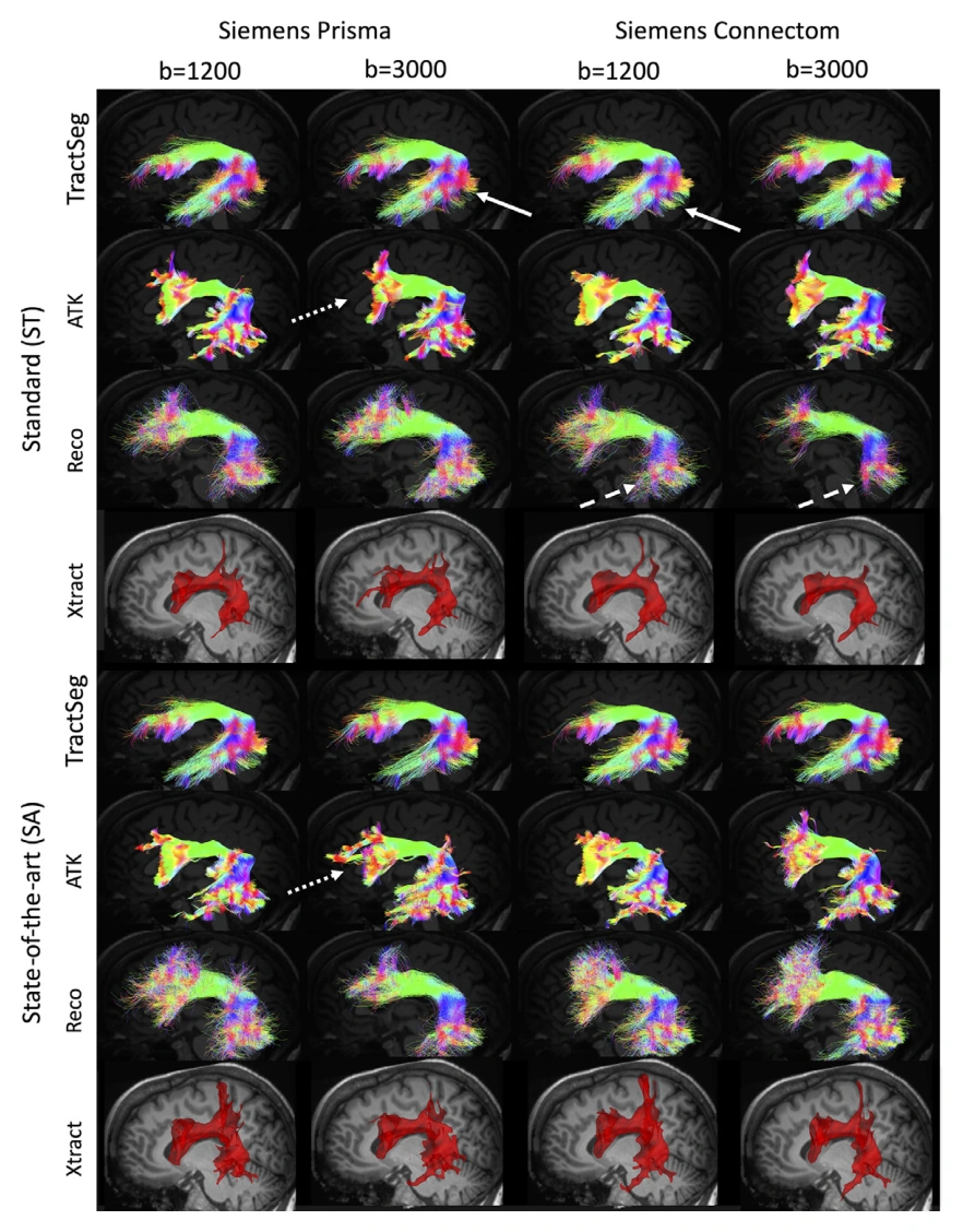 Arcuate fasciculus reconstructions vary across scanners, acquisitions, diffusion weighting, and segmentation workflows.