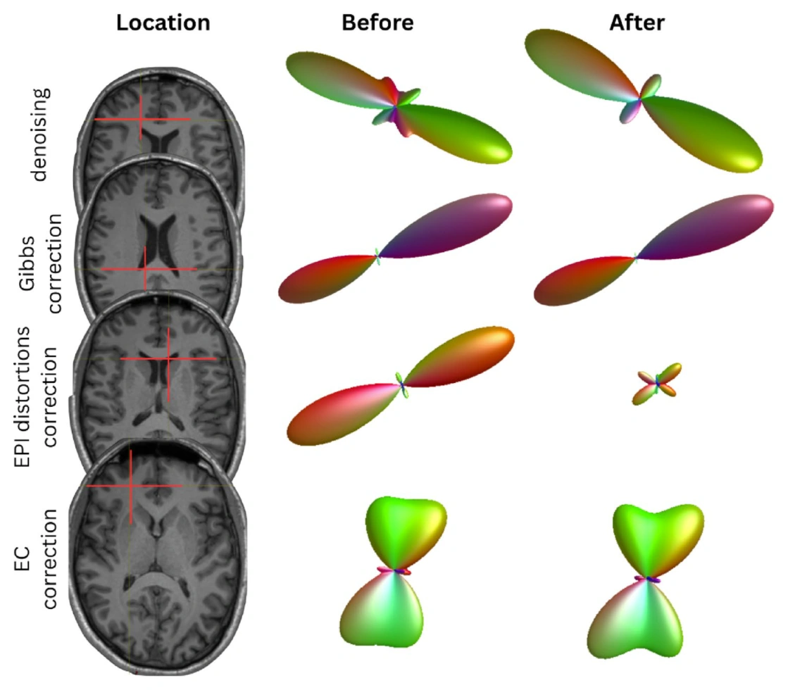 Effects of individual diffusion MRI preprocessing steps on fiber orientations and tractography.