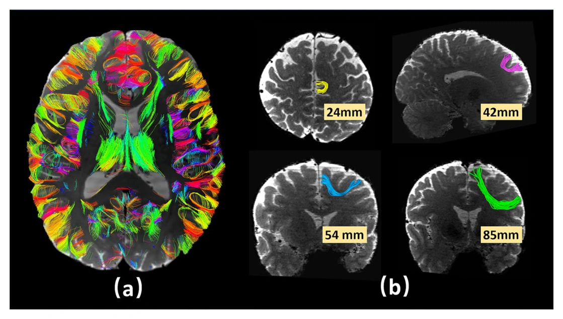 Short association fibers reconstructed in superficial white matter using high-resolution diffusion MRI.