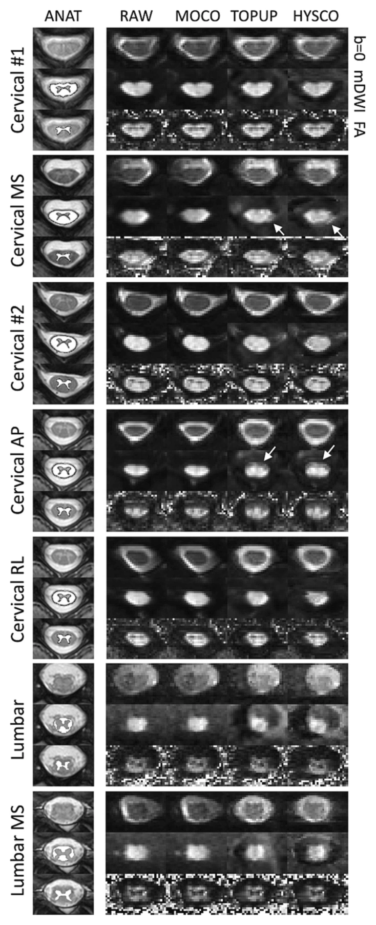 Examples of spinal cord image geometry and contrast after alternative distortion-correction approaches.