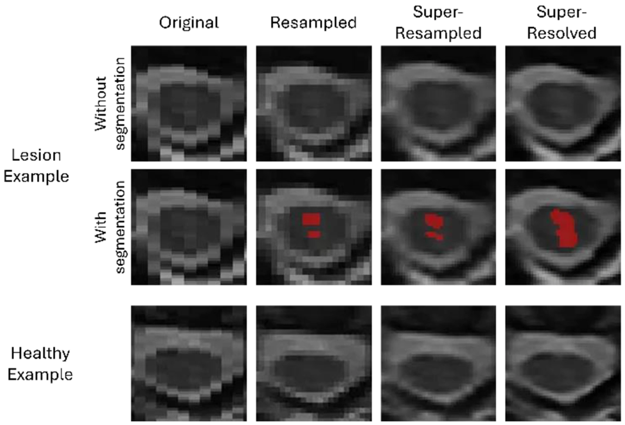 Spinal cord image resolution influences the visibility and segmentation of MS lesions.