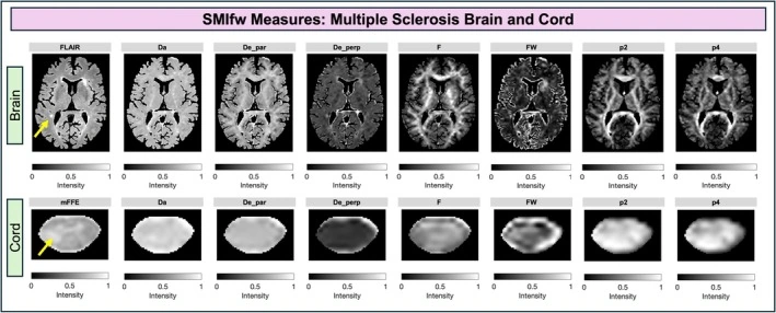 Standard model imaging parameter maps in the brain and spinal cord of a person with relapsing-remitting MS.