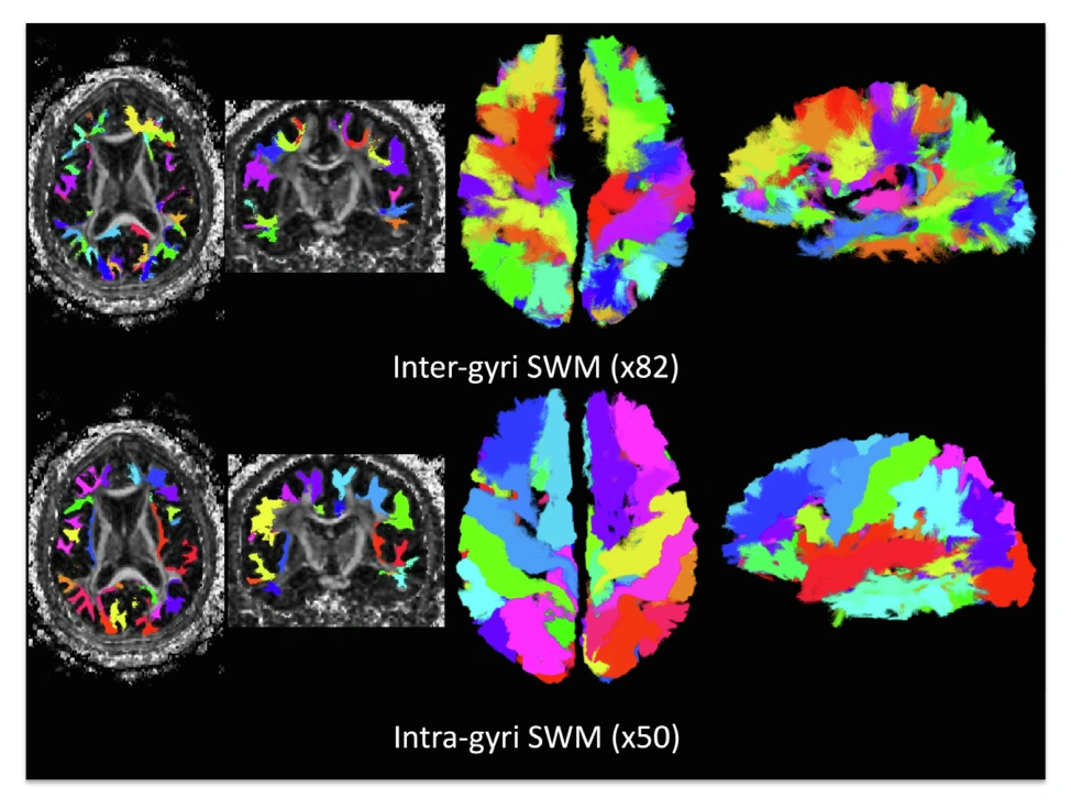 The short superficial white matter pathways used to characterize aging across longitudinal cohorts.