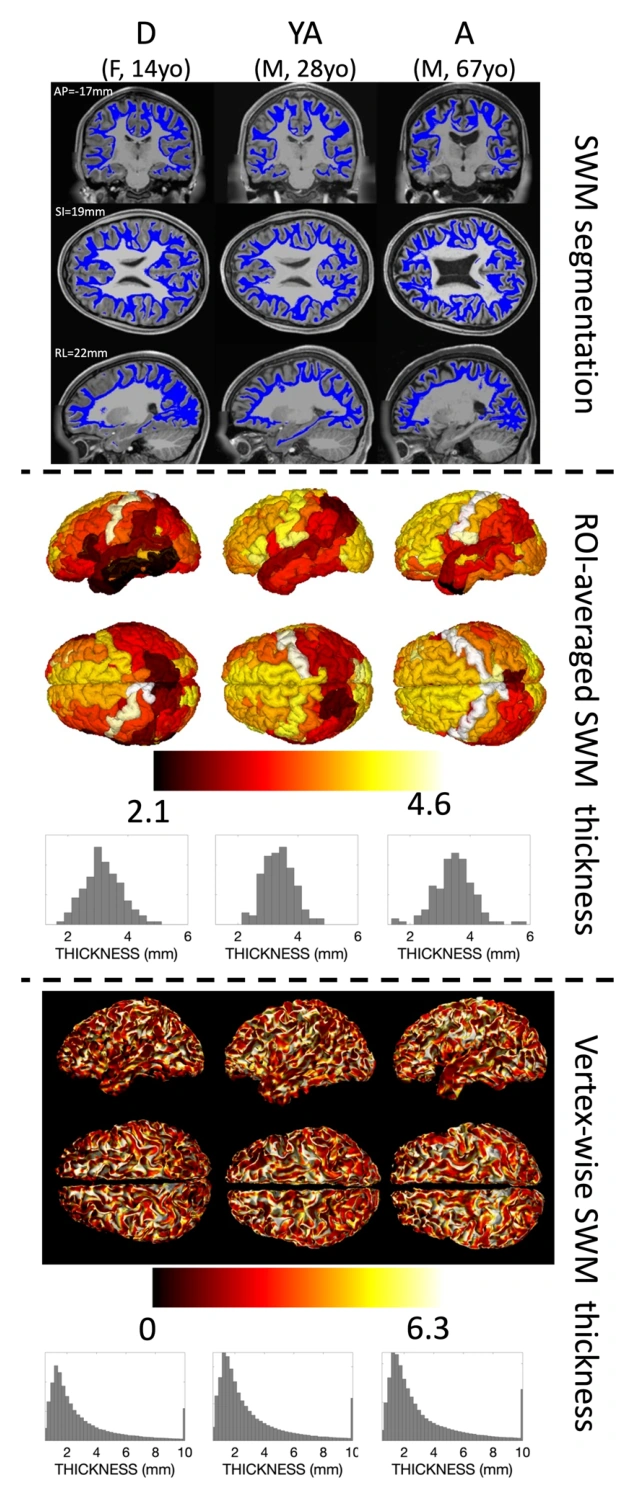 Superficial white matter segmentation and thickness maps across representative ages.