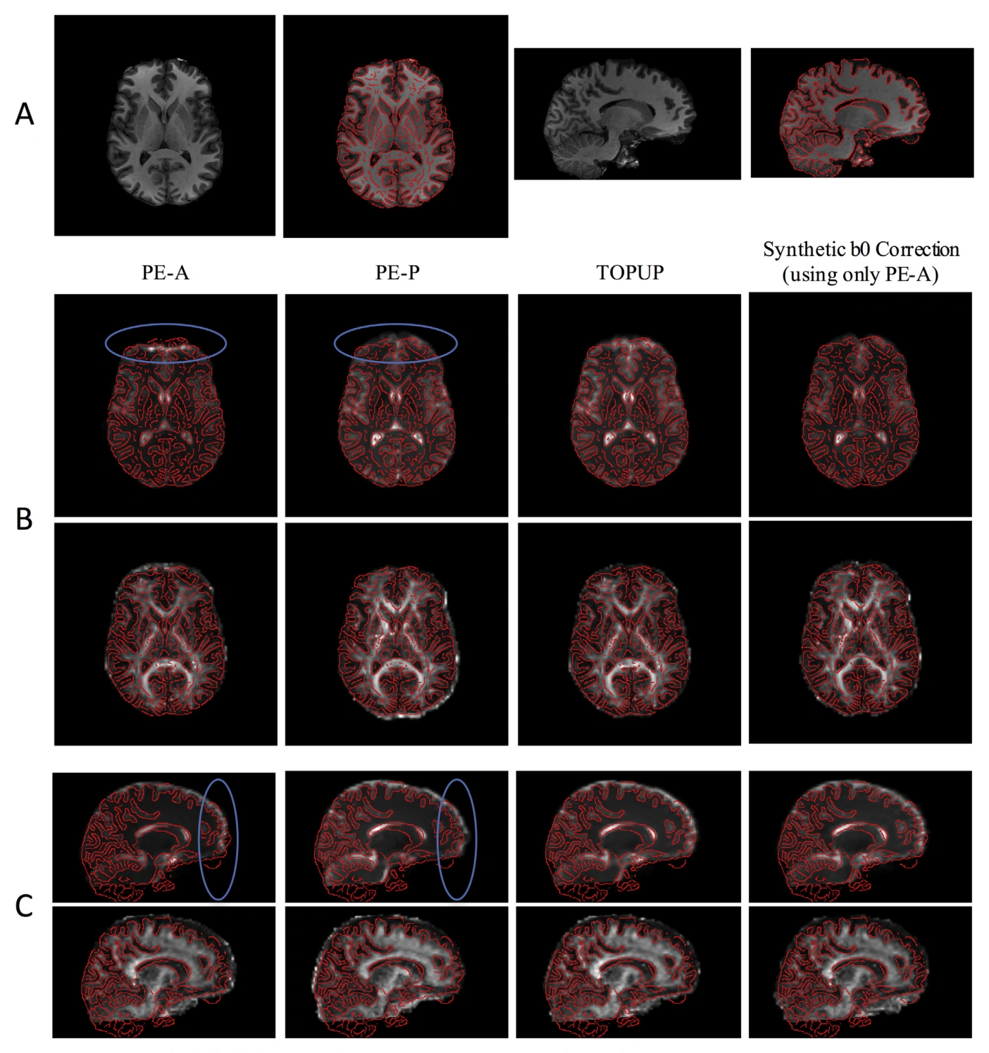 Synthesized b0 distortion correction compared with uncorrected and reversed-encoding results.