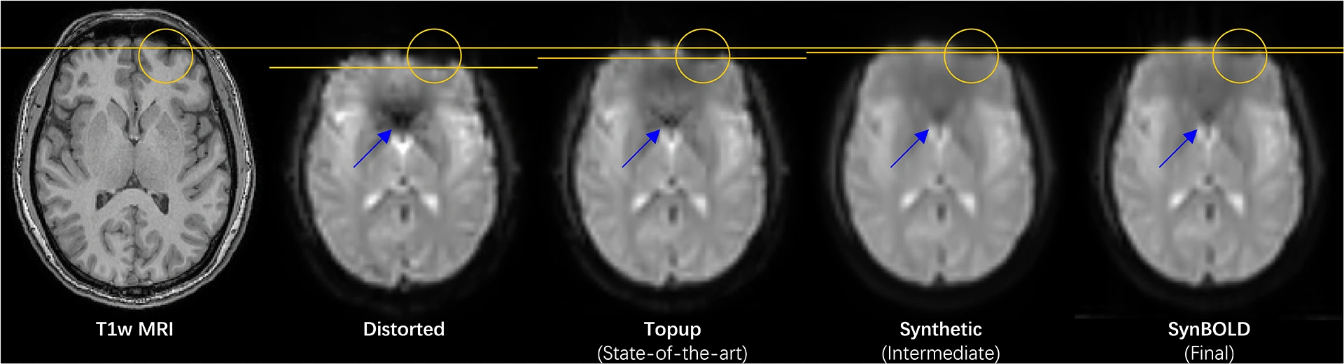 Example functional MRI geometry before and after SynBOLD-DisCo correction, compared with a structural reference.