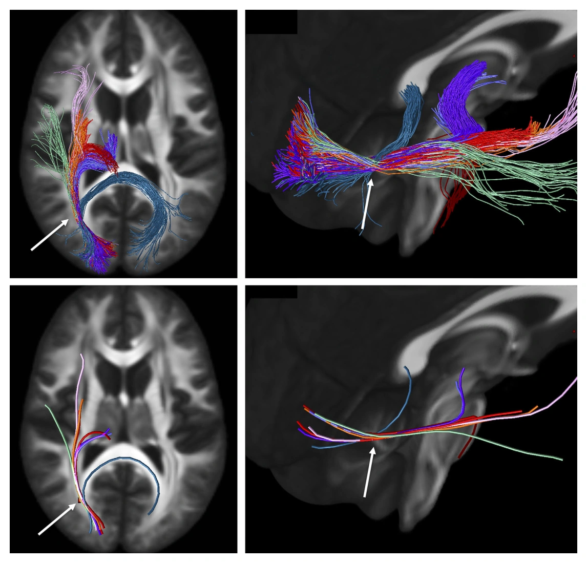 Distinct pathways converge within a small occipital white matter region, illustrating the tractography bottleneck problem.