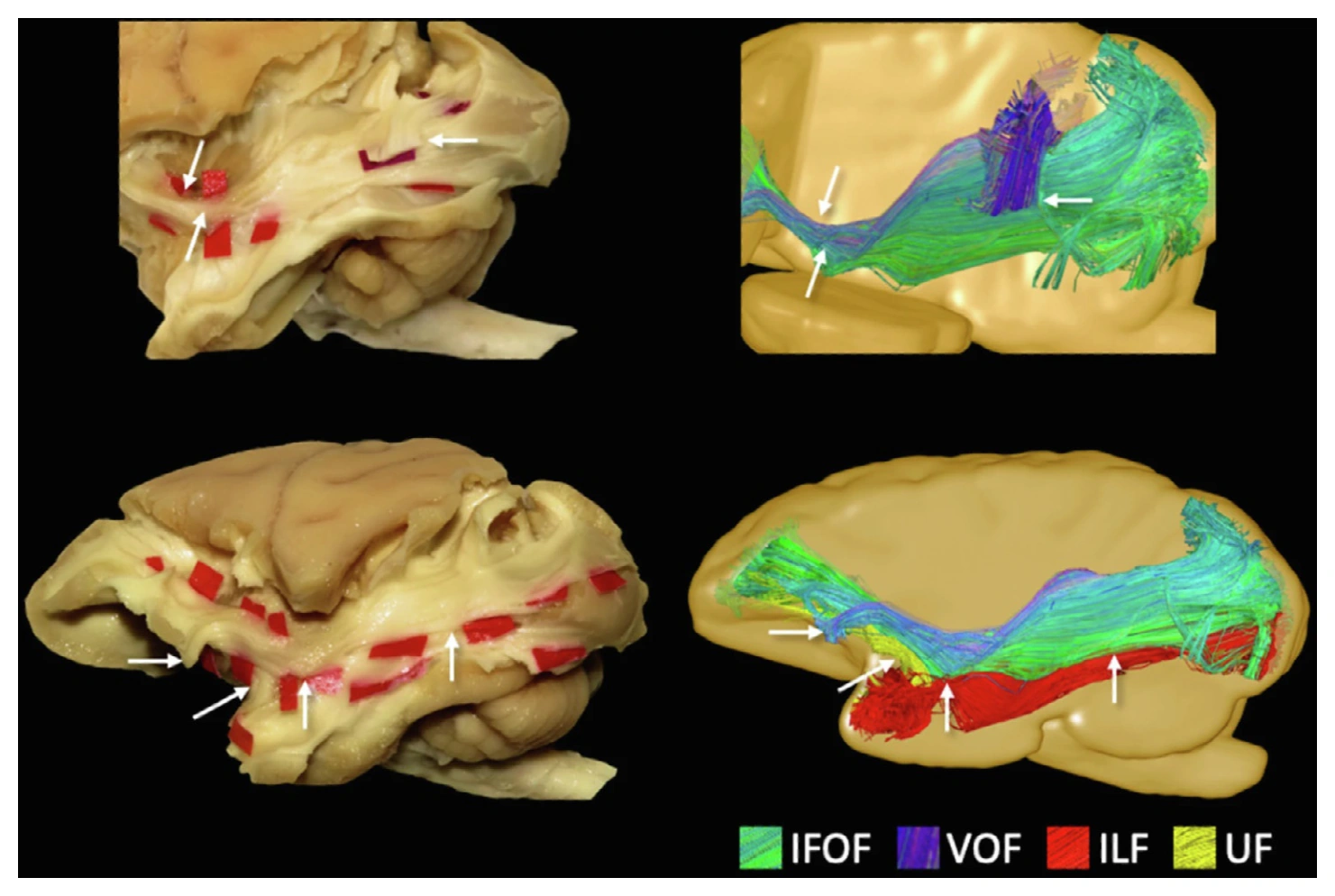 Microdissection and ex vivo diffusion tractography compared for association pathways in the same monkey brain.