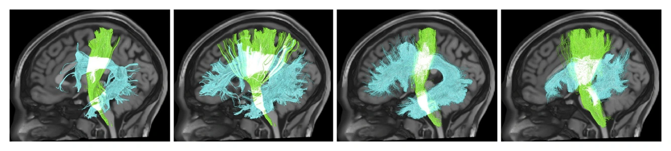 Differences in anatomical definitions and dissection protocols alter reconstructed pathway size, shape, and connections.