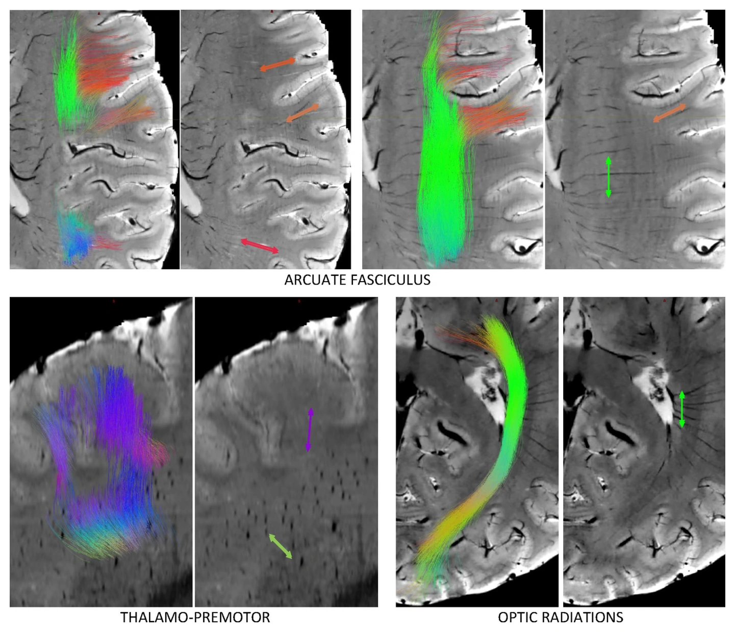 Examples of alignment and misalignment between white matter tract orientations and vasculature.