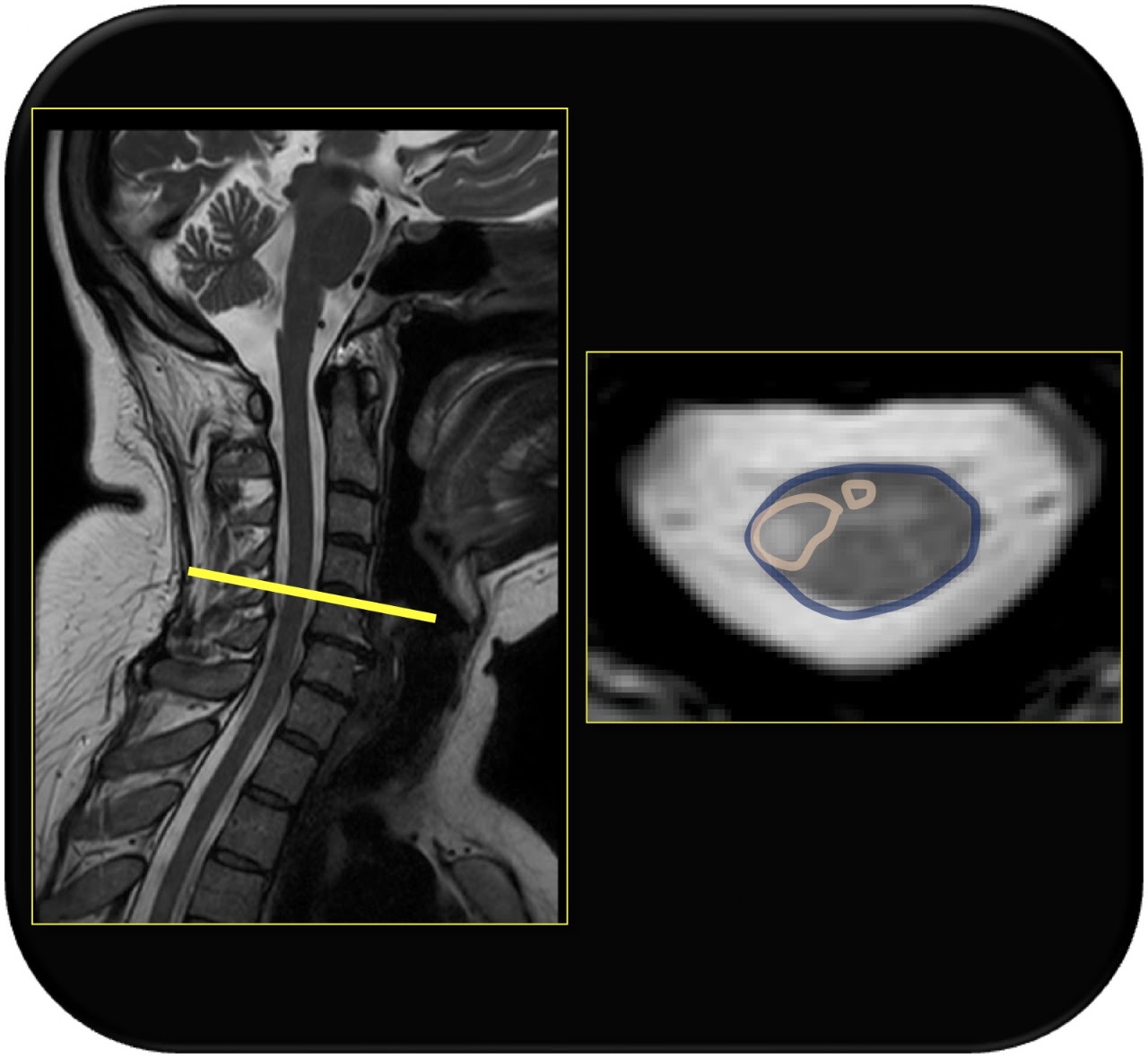 Spinal cord MRI and tractography visualization from the lab’s research page